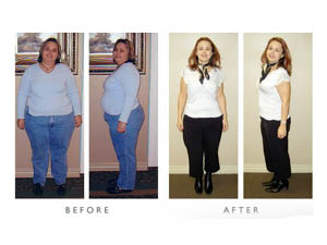 After gastric band surgery