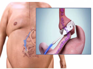 Gastric Band Bypass