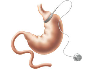 Gastric Band Indications