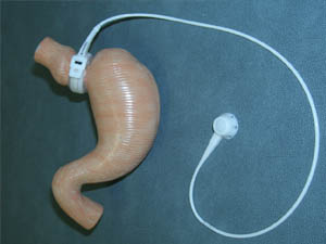 Laparoscopic Adjustable Gastric Band