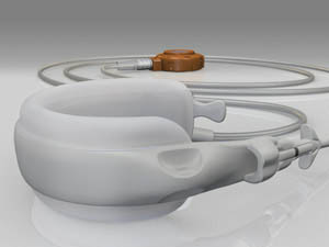 Swedish Adjustable gastric band